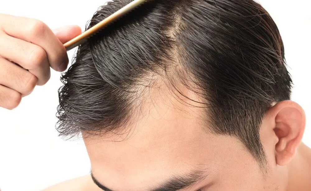 minoxidil生髮水 香港 | 邊度買 | 價錢